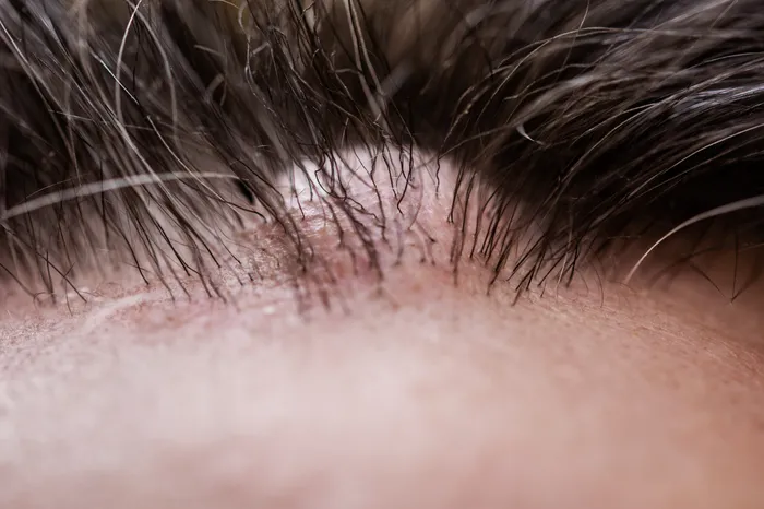 Close-up of a pilar cyst on the scalp