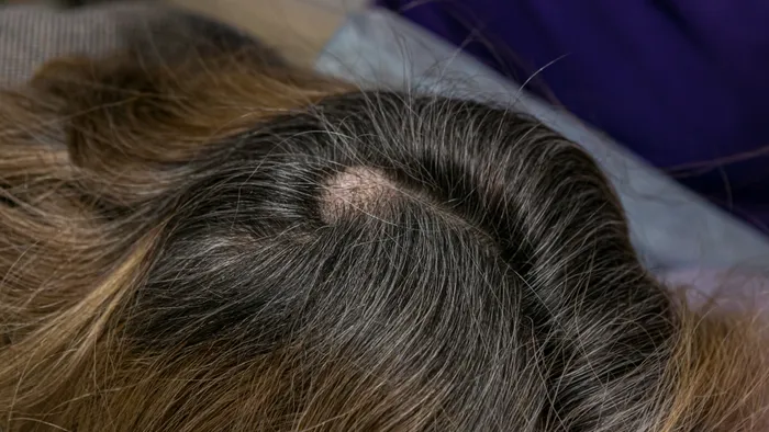 Pilar cyst at the back of the head