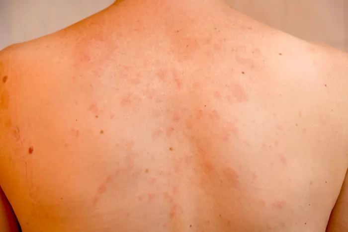 Pityriasis rosea rash on back