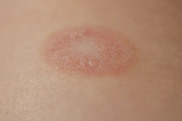 Close-up of pityriasis rosea rash