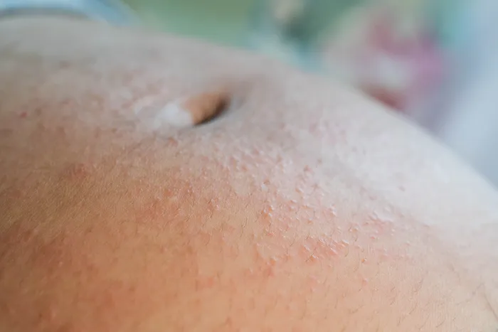 Pregnant woman with skin rash