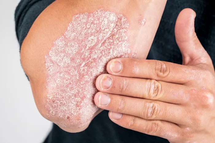 Close-up of psoriasis on skin