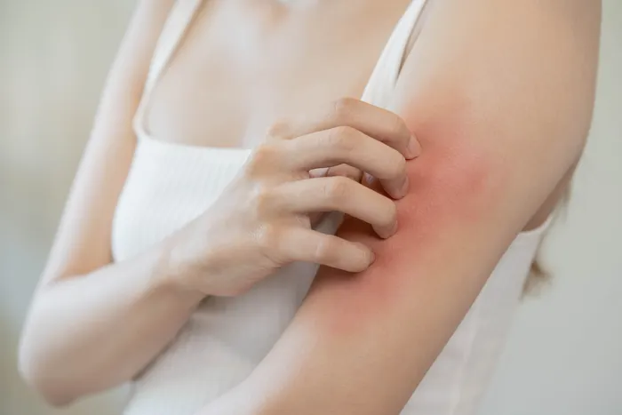 Woman scratching skin rash on arm