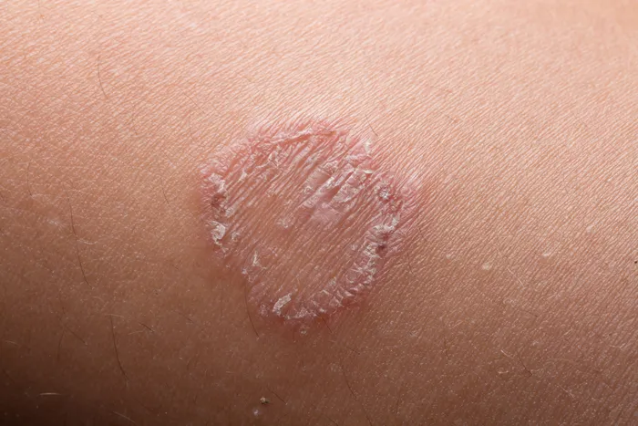 Close-up of ringworm