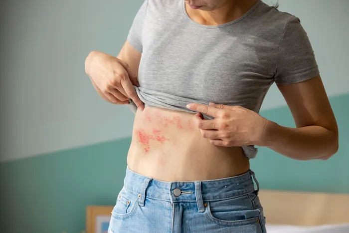 Shingles on woman's stomach