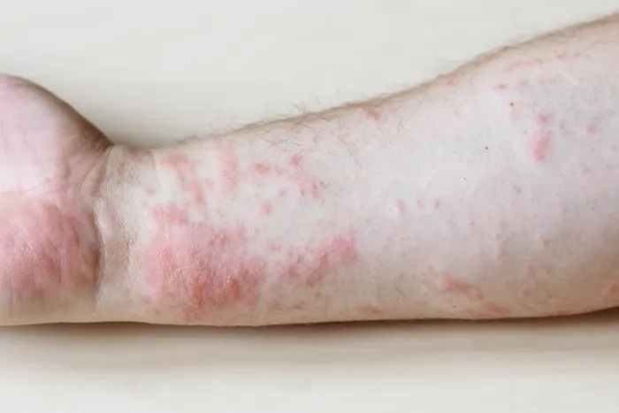 Close-up of skin allergy reaction