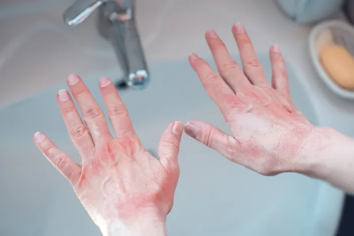 Skin alergy on hands