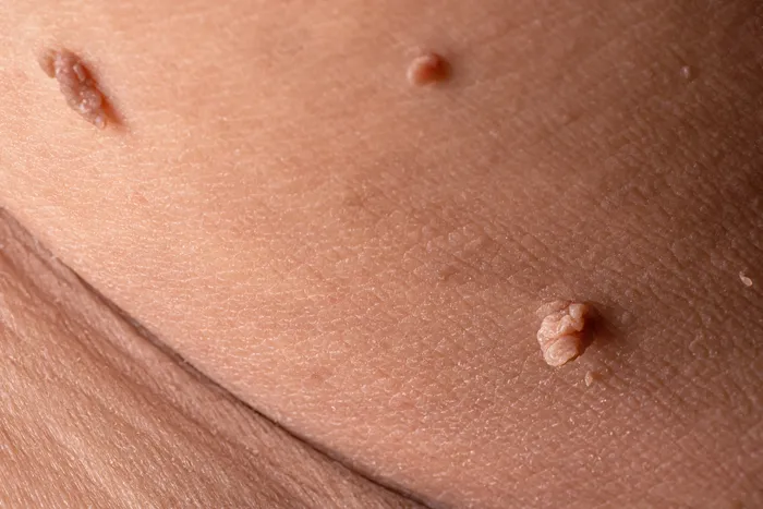 Close-up of skin tags