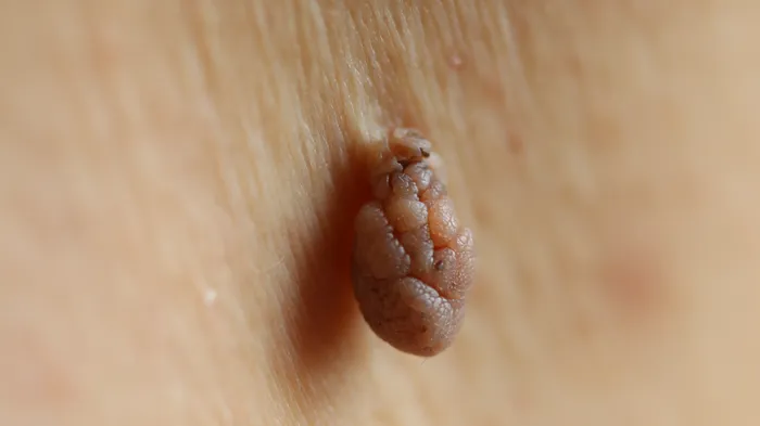 Close up of individual skin tag