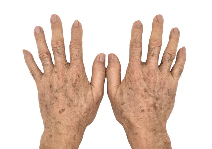 Solar lentigo on hands