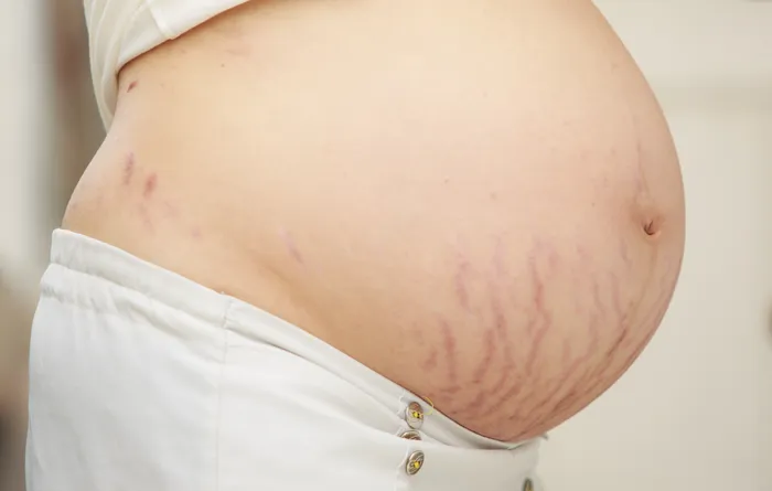 Pregnant woman with stretch marks