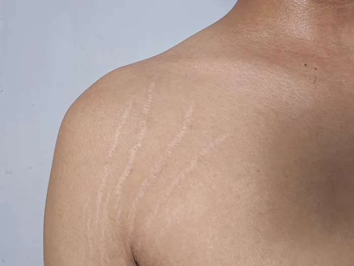 Stretch marks on shoulder caused by growth