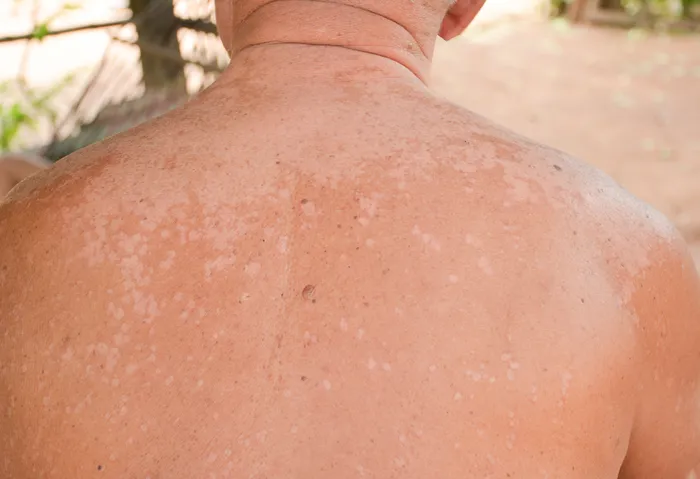 Close-up of tinea versicolor on back