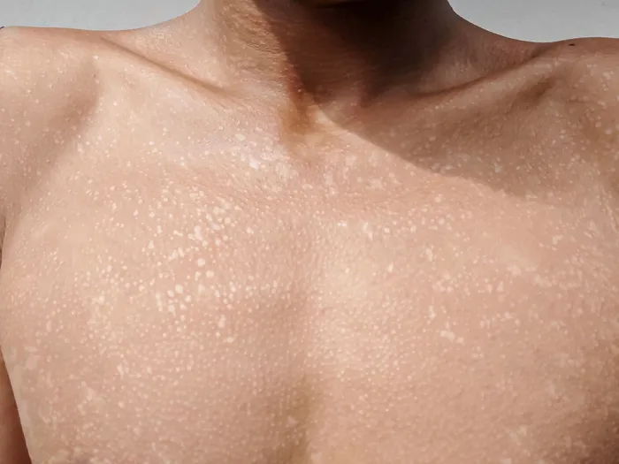 Close-up of tinea versicolor on chest