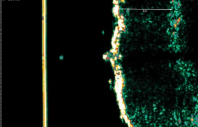 Ultrasound before GentleCure treatment