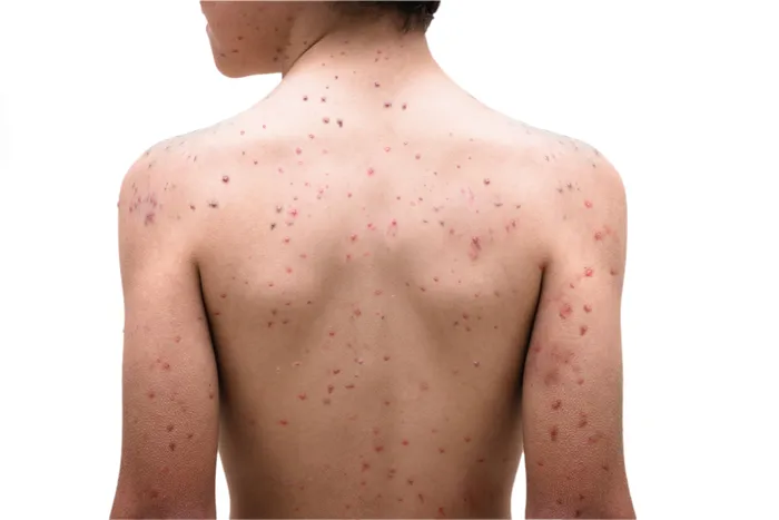 Child with viral rash on torso