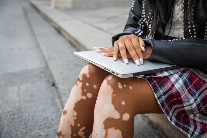 A woman sitting with vitiligo on her legs