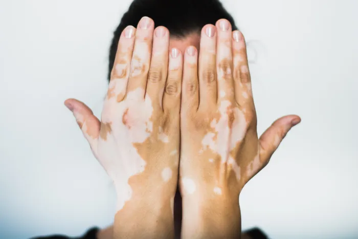 a man holding his hand with vitiligo in front of his face