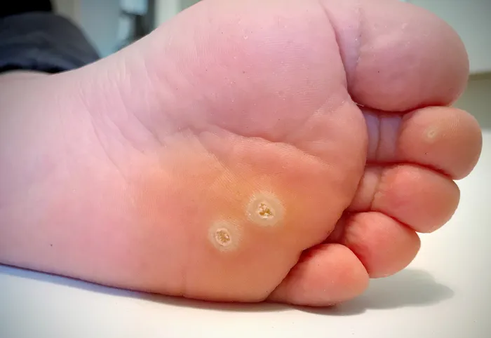 Warts on sole of the foot